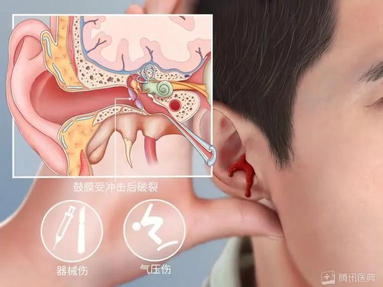 颅内感染！脑脊液流淌不止！一岁半娃掏耳屎致鼓膜穿孔  -图2